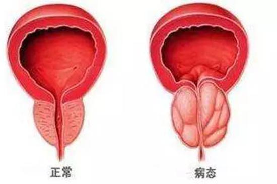 前列腺炎癥能否自愈，解析、理解與應(yīng)對(duì)，前列腺炎癥能否自愈，解析、應(yīng)對(duì)及理解指南