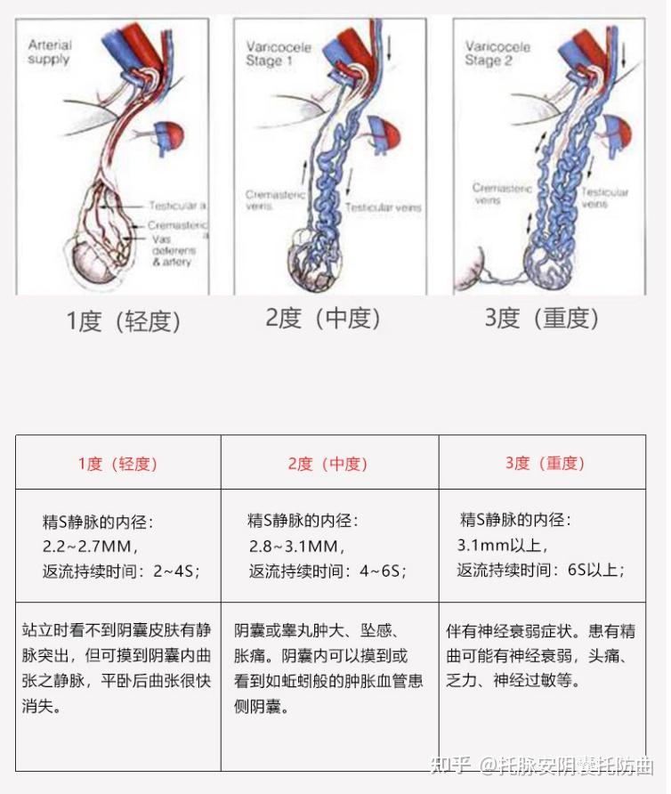 精索靜脈曲張三個(gè)程度圖詳解，精索靜脈曲張三個(gè)程度詳解圖解