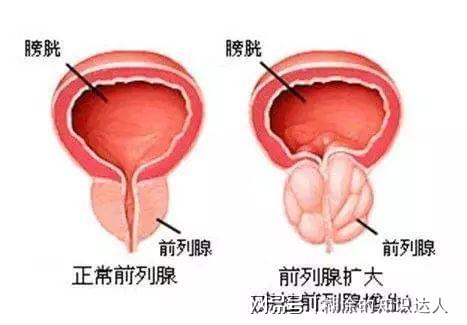 前列腺肥大最佳治療效果探討，前列腺肥大最佳治療方案的探討與研究