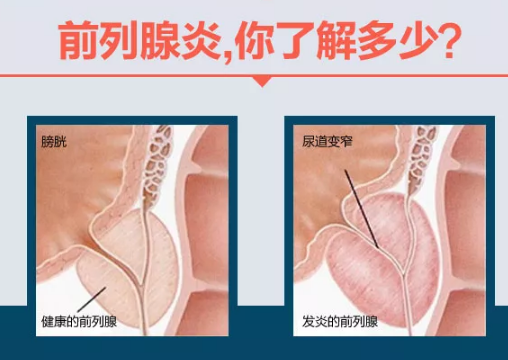 前列腺炎的治愈可能性，理解與探索，前列腺炎的治愈可能性，深入理解與探索