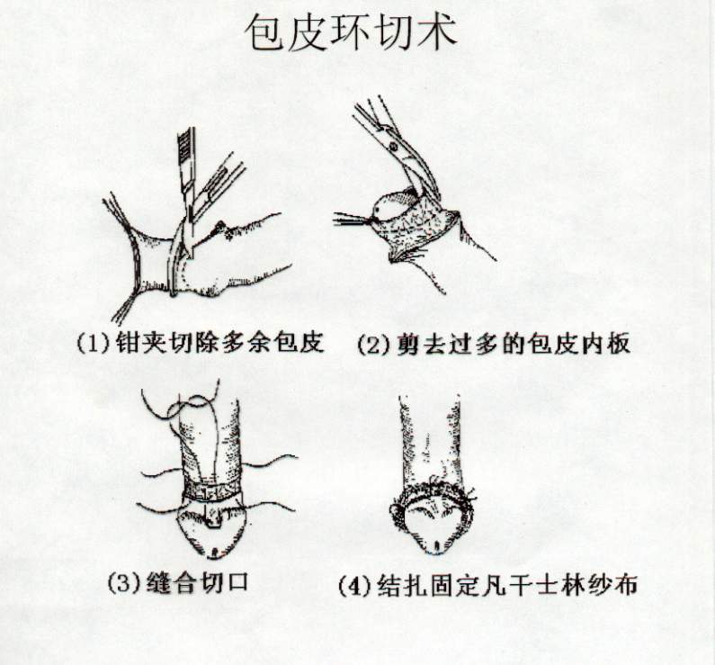 關(guān)于包皮手術(shù)后多久可以同房的問題解答，包皮手術(shù)后恢復(fù)與同房時間指南