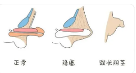 正規(guī)包莖手術(shù)費(fèi)用詳解，正規(guī)包莖手術(shù)費(fèi)用全面解析