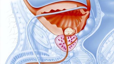 前列腺炎的治療費(fèi)用分析，前列腺炎治療費(fèi)用詳解