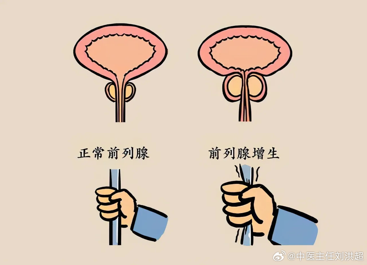 前列腺結(jié)石與性功能障礙，是否存在關(guān)聯(lián)？，前列腺結(jié)石與性功能障礙的關(guān)聯(lián)探討，是否存在潛在聯(lián)系？