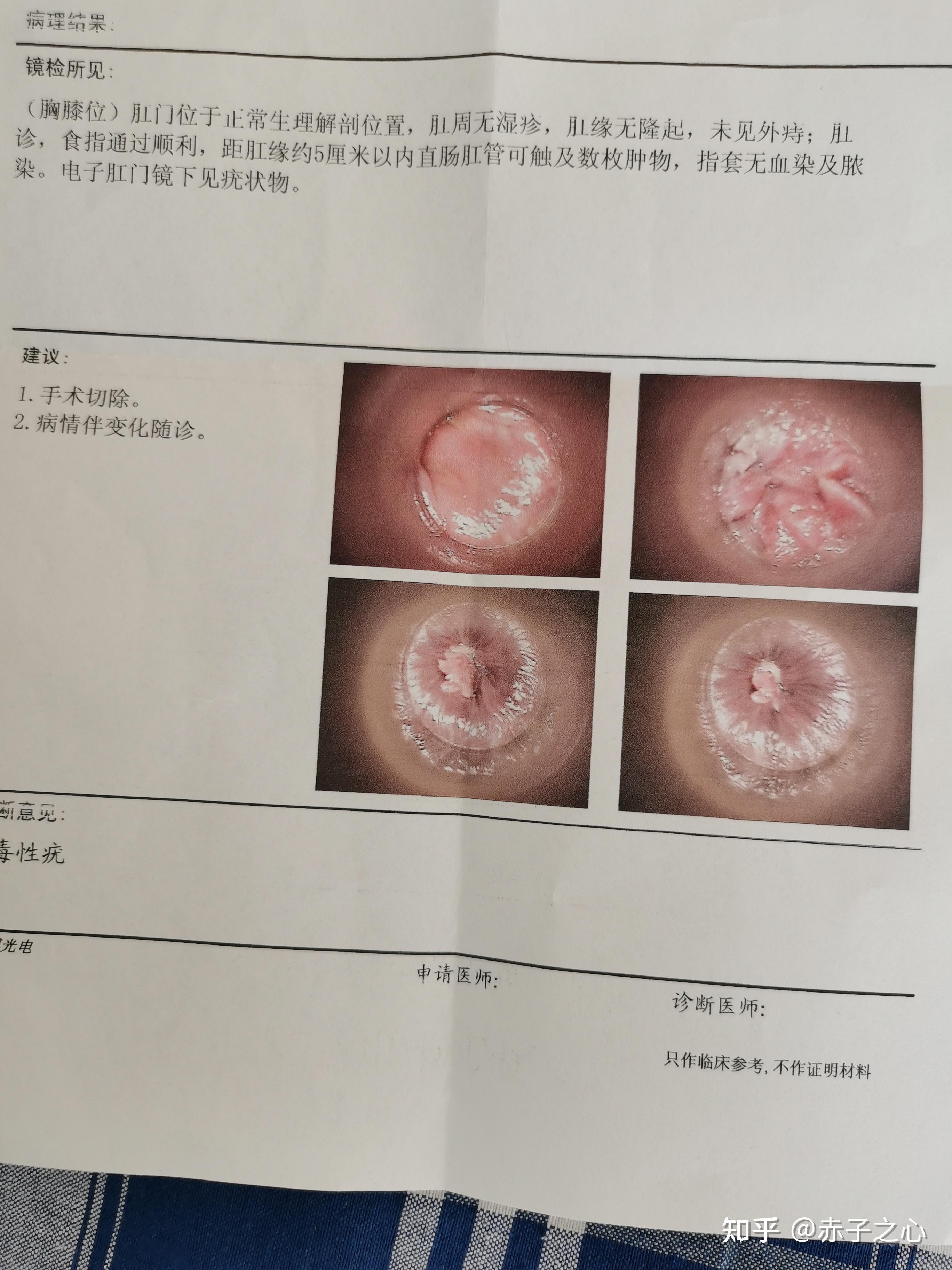 患者尖銳治愈的真實(shí)過(guò)程，患者尖銳濕癥的治愈之路