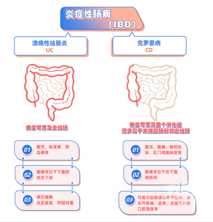 潰瘍性結腸炎與克羅恩病的區(qū)別，潰瘍性結腸炎與克羅恩病的差異解析