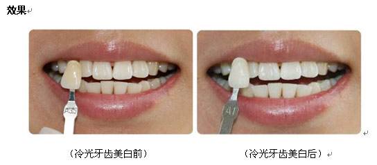 美白牙齒，打造燦爛笑容的關(guān)鍵步驟，美白牙齒，燦爛笑容的秘訣與關(guān)鍵步驟